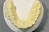 歯牙欠損：矯正治療後