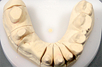 歯牙欠損：矯正治療前