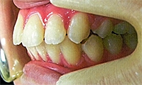 出っ歯：矯正治療後